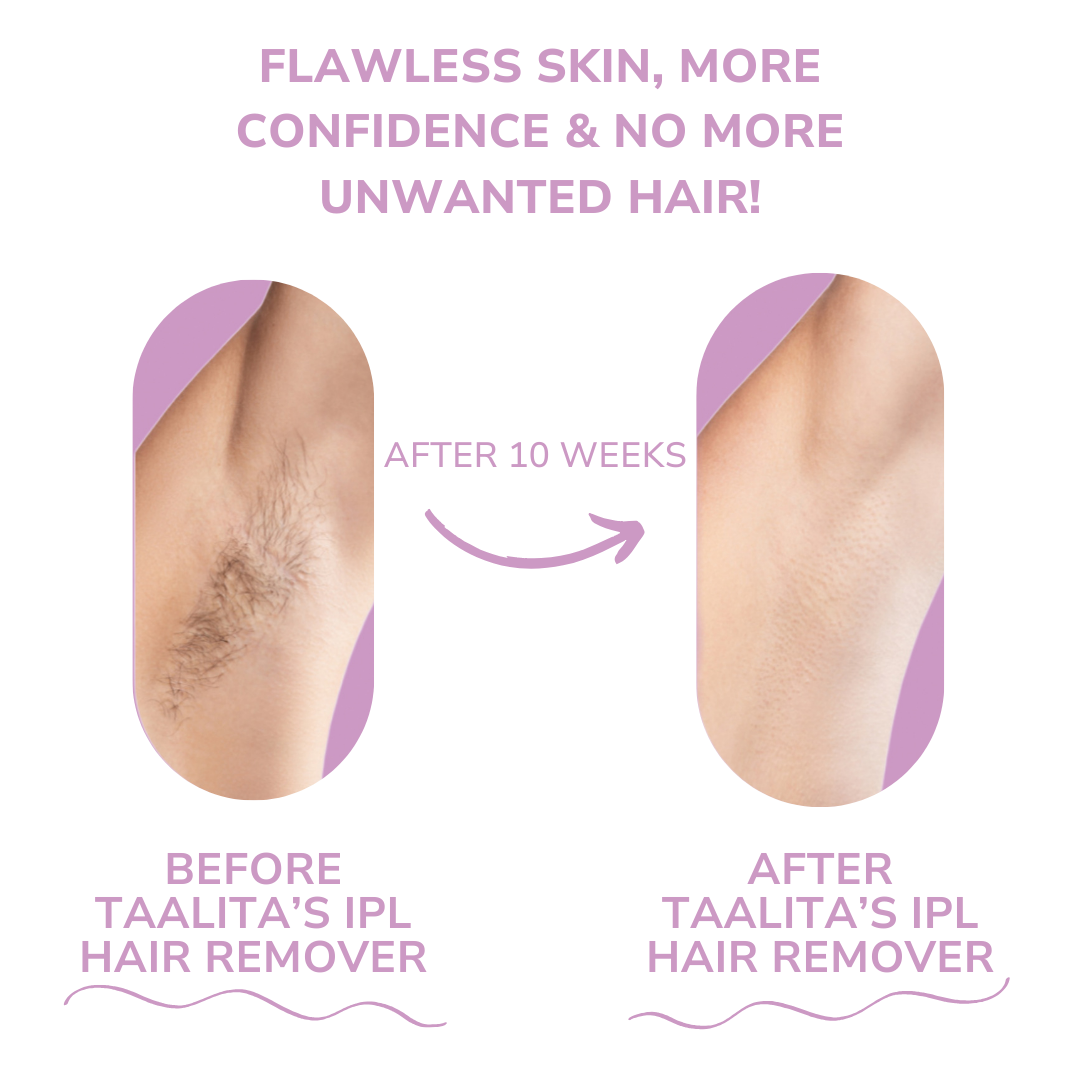 Mini Laser Hair Removal